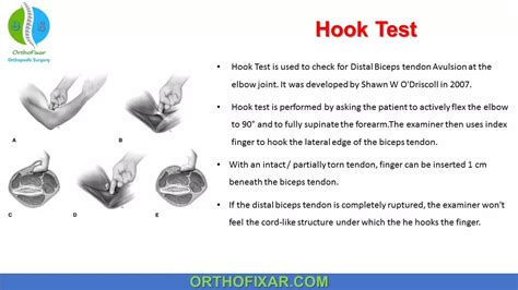 positive hook test biceps